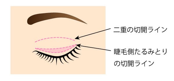 睫毛側たるみとりの切除部分