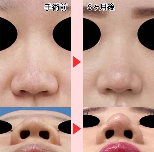 コラム　鼻尖縮小のリスク　症例写真　鼻尖縮小（3D法）＋軟骨移植＋ストラット　６ヶ月後　①