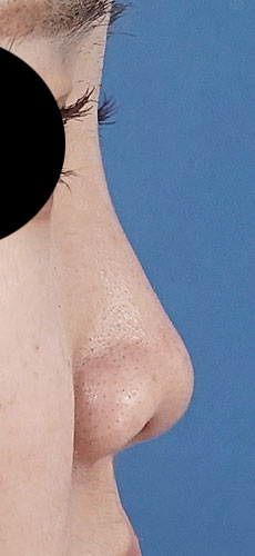 鼻尖縮小、軟骨移植、鼻孔縁挙上、Ｉ型プロテーゼ　半年後　右側面のAfterの写真