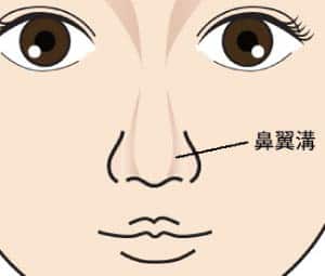 コラム　鼻尖縮小のリスク　鼻翼溝