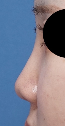 鼻尖縮小＋軟骨移植＋鼻孔縁挙上＋Ｉ型プロテーゼ　　半年後　左側面