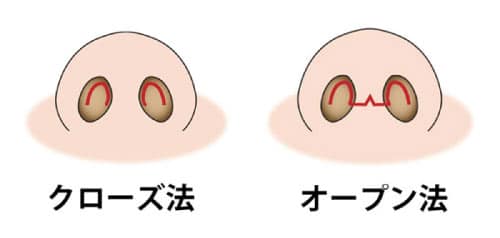 コラム　鼻尖縮小のリスク　クローズ法とオープン法