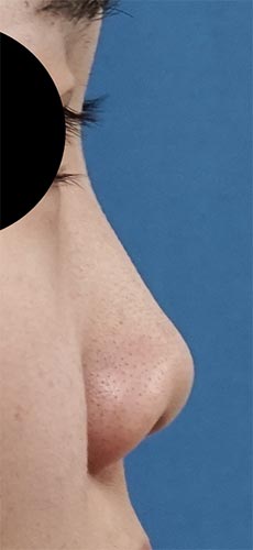 鼻尖縮小、軟骨移植、鼻孔縁挙上、Ｉ型プロテーゼ　半年後　右側面のBefore写真