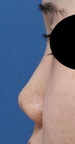 鼻尖縮小、軟骨移植、鼻孔縁挙上、Ｉ型プロテーゼ　半年後　左側面のBefore写真