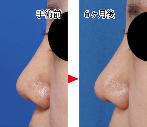 コラム-鼻尖縮小はアップノーズになるの？　通常鼻尖縮小症例写真③　鼻尖縮小＋プロテーゼ　左側面　６ヶ月後
