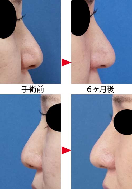 コラム-鼻尖縮小はアップノーズになるの？　３D法鼻尖縮小症例写真①　左右　６ヶ月後