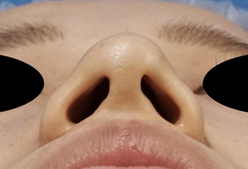鼻尖縮小（３D法）＋ストラット＋他院修正、鼻翼縮小（内＋外）　下から　手術前