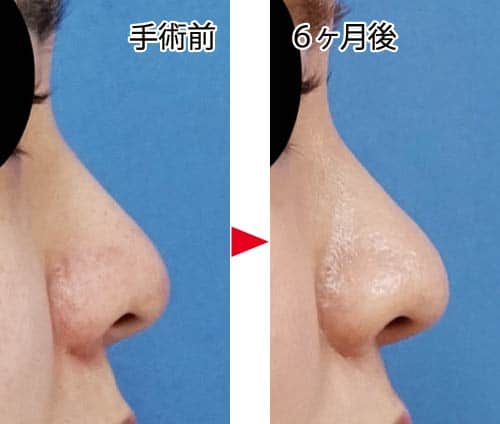 コラム-鼻尖縮小はアップノーズになるの？　通常鼻尖縮小症例写真②　鼻尖縮小＋プロテーゼ　左側面　６ヶ月後