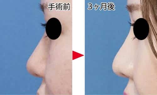 コラム-鼻尖縮小はアップノーズになるの？　通常鼻尖縮小症例写真①　鼻尖縮小＋プロテーゼ　左側面　3jヶ月後