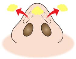 コラム　鼻尖縮小はアップノーズになるの？　図②軟部組織の除去2