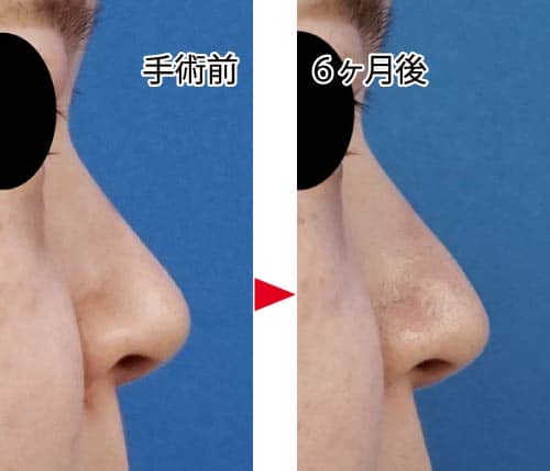 コラム-鼻尖縮小はアップノーズになるの？　通常鼻尖縮小症例写真④　鼻尖縮小＋鼻翼縮小（内＋外）　右側面　６ヶ月後
