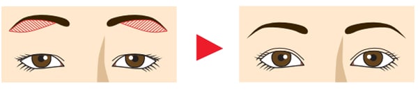眉下切開　切開範囲イラスト　どこを切るの