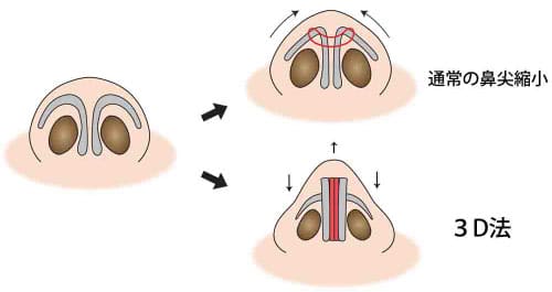 コラム　鼻尖縮小の症例写真　図④通常の鼻尖縮小と３D法