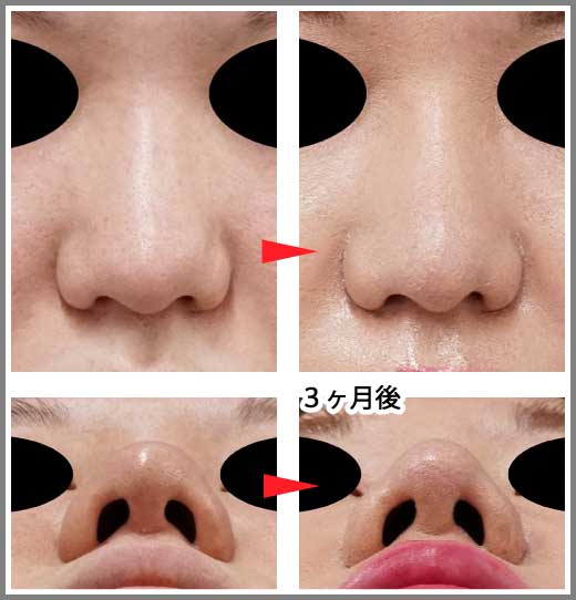 鼻尖縮小コラム症例写真②　鼻尖縮小＋プロテーゼ　3ヶ月後