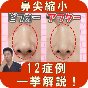 鼻尖縮小（鼻尖形成）症例写真（術前術後写真）を一挙解説！（動画付き）