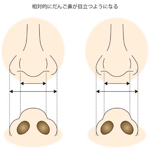 鼻尖縮小コラム症例写真③　鼻尖縮小＋鼻翼縮小（内＋外）　3ヶ月後-鼻翼縮小イラスト