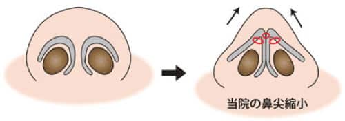 コラム　鼻尖縮小の症例写真　図③鼻尖縮小のイラスト ２