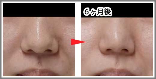 鼻尖縮小コラム症例写真⑩ー４　鼻尖縮小（３D法）