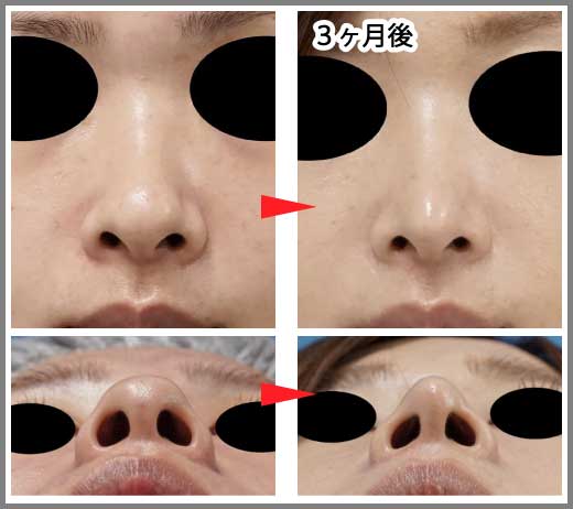 鼻尖縮小コラム症例写真⑫ー６　鼻尖縮小（３D法）＋耳介軟骨移植