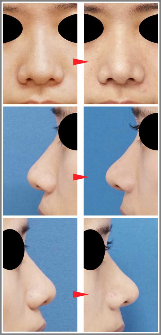 鼻尖縮小コラム症例写真⑨ー３　鼻尖縮小（３D法）