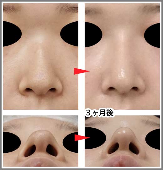 鼻尖縮小コラム症例写真①　鼻尖縮小＋プロテーゼ　3ヶ月後