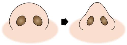 コラム　鼻尖縮小の症例写真　図①鼻尖縮小変化