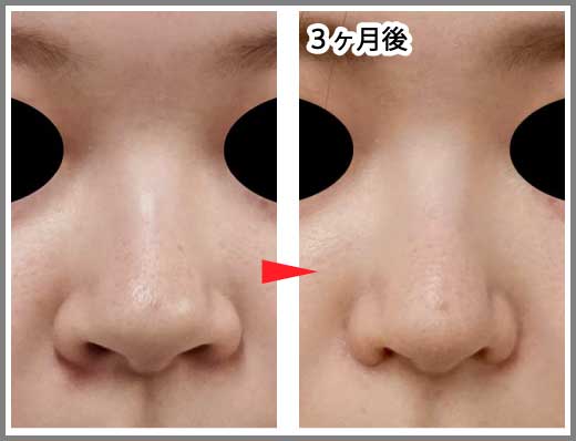 鼻尖縮小コラム症例写真④　鼻尖縮小＋鼻翼縮小（内＋外）　3ヶ月後