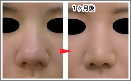 鼻尖縮小コラム症例写真⑪ー５　鼻尖縮小（３D法）