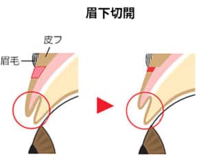 眉下切開の場合の厚み