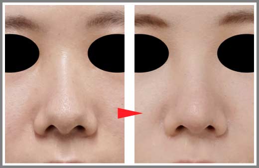 図⑤コラム　鼻尖縮小の症例写真　説明部