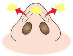 コラム　鼻尖縮小の症例写真　図②軟部組織の除去2