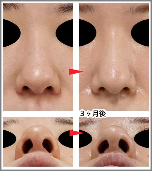 鼻尖縮小コラム症例写真⑥　鼻尖縮小　3ヶ月後