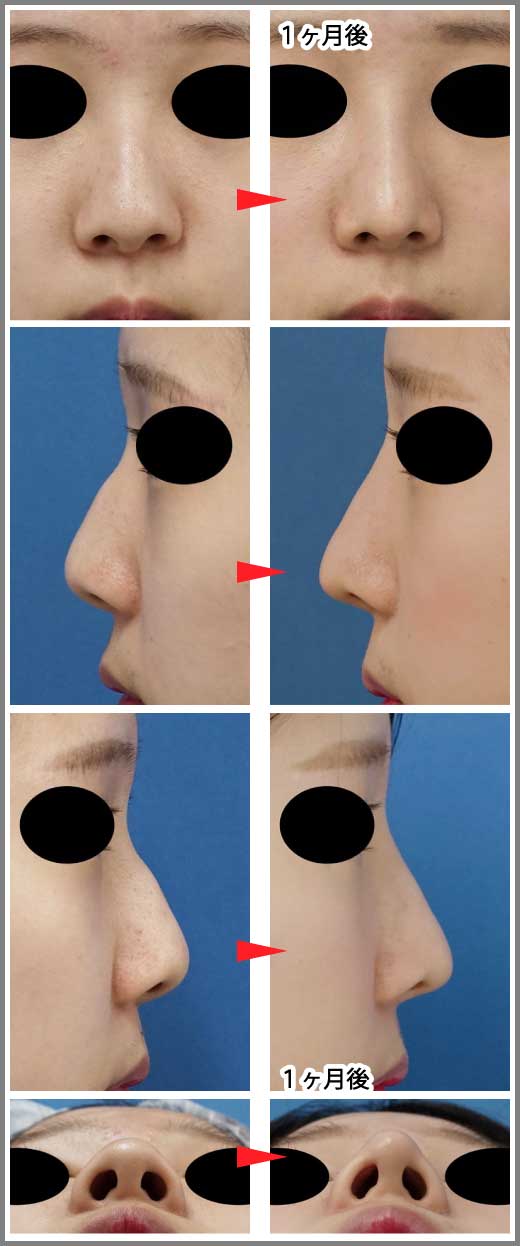 鼻尖縮小コラム症例写真⑦ー１　鼻尖縮小（３D法）＋プロテーゼ　１ヶ月後