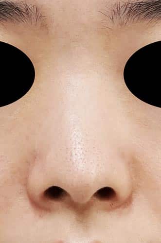 鼻孔縁下降、鼻プロテーゼ（Ｉ型）　3か月後　正面のBefore写真