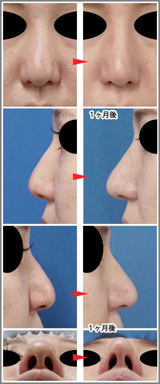鼻尖縮小コラム症例写真⑧ー２　鼻尖縮小（３D法）　１ヶ月後