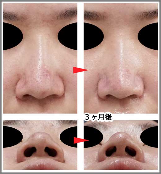 鼻尖縮小コラム症例写真⑤　鼻尖縮小＋鼻翼縮小（内＋外）　3ヶ月後