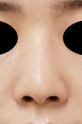 鼻孔縁下降、鼻プロテーゼ（Ｉ型）　3か月後　正面のAfterの写真