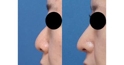 鼻尖縮小、鼻中隔延長、プロテーゼ、鼻翼縮小（内側＋外側）