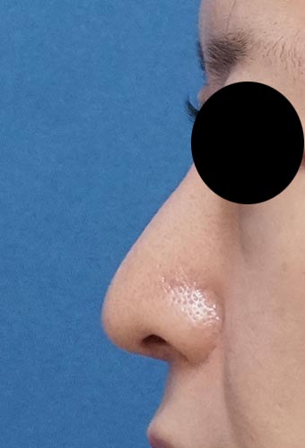 鼻尖縮小、鼻中隔延長、プロテーゼ、鼻翼縮小（内側＋外側）　左側面　6か月後