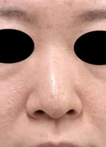 鼻尖縮小、鼻中隔延長、プロテーゼ、鼻翼縮小（内側＋外側）　正面　術前