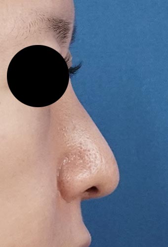 鼻尖縮小、鼻中隔延長、プロテーゼ、鼻翼縮小（内側＋外側）　右側面　６か月後のAfterの写真