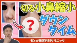 切る小鼻縮小のダウンタイムについてのサムネイル