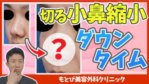 切る小鼻縮小術のダウンタイムについて
