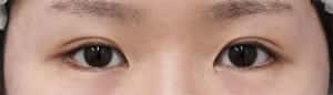 目頭切開の症例写真（手術前）