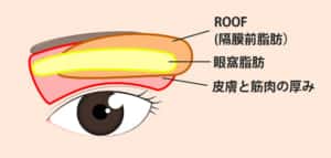 上まぶたの厚みの原因、位置による種類
