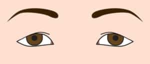 たるみによる三角目