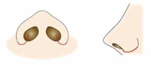 小鼻縮小（内側法＋外側法）の切開線イラスト