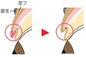 二重部分で皮膚切除すると厚みは増す