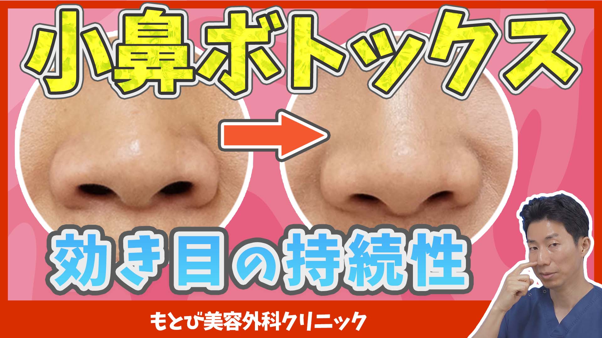 小鼻ボトックスの効果の持続性について