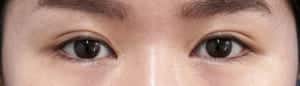 目頭切開の症例写真（手術後）